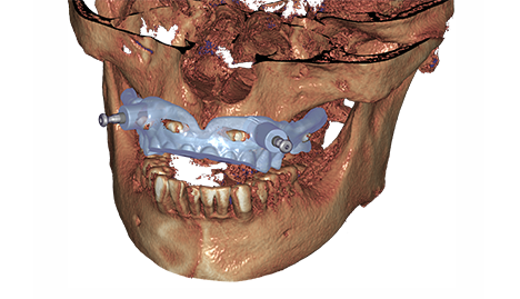 https://www.onexdental.com/yuklemeler/gorsel/05_anchor_pins.png
