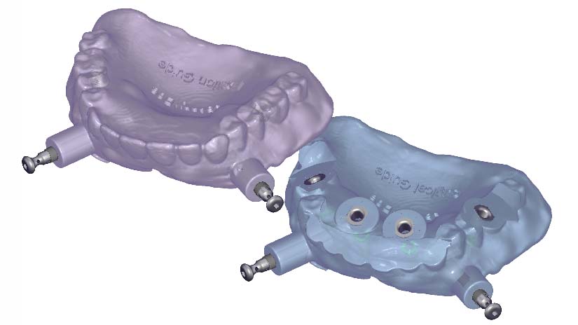 https://www.onexdental.com/yuklemeler/gorsel/06_denture_based_surgical_and_fixation_guide_cropped.jpg