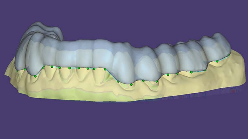 https://www.onexdental.com/yuklemeler/gorsel/exocad_dentalcad_3_3_chemnitz_improved_ai-assisted_bite_splint_designs.jpg
