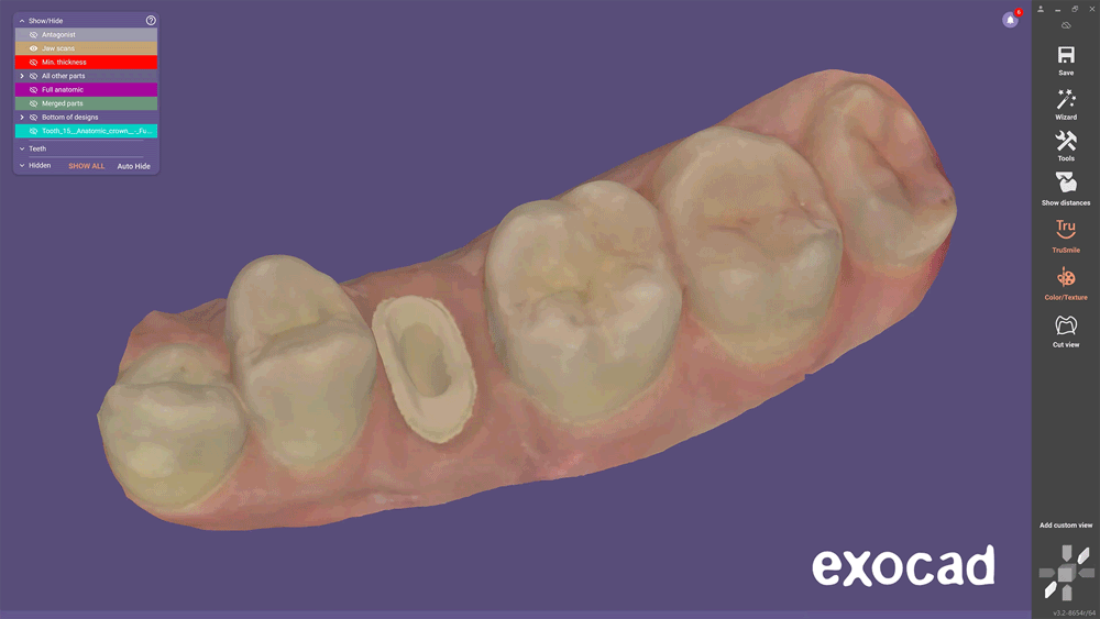 https://www.onexdental.com/yuklemeler/gorsel/exocad_dentalcad_elefsina_features_6_post_and_core.jpg