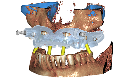 https://www.onexdental.com/yuklemeler/gorsel/exocad_exoplan_galway_new_edentulous_case_planning.png