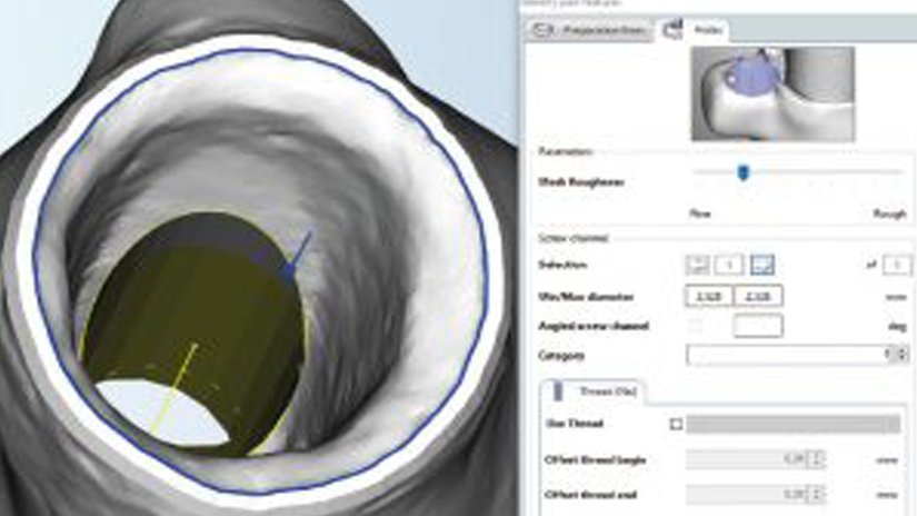 https://www.onexdental.com/yuklemeler/gorsel/hyperdent_bos-luk-frezeleme.png