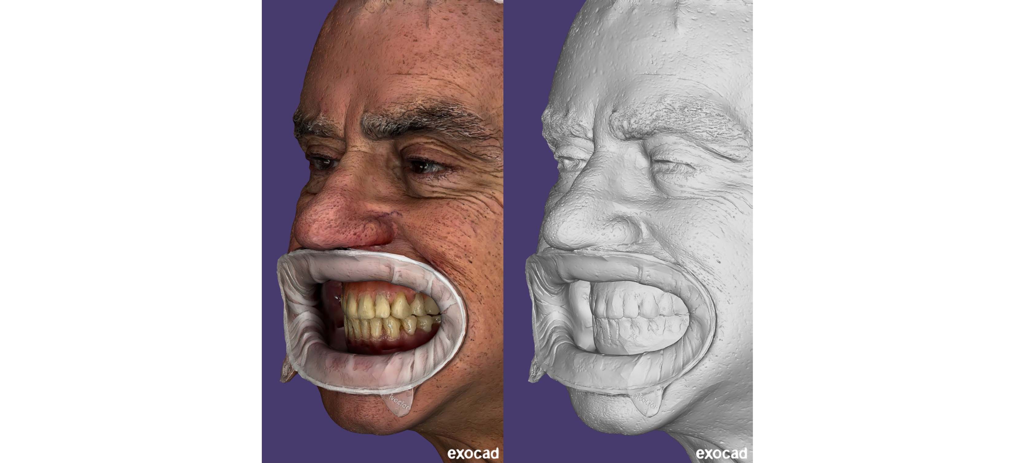 https://www.onexdental.com/yuklemeler/gorsel/qlone-dental-exocad-tasarim-go-ru-ntu-leri1.jpg